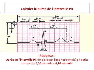 Calculer la durée de l’intervalle PR
Réponse :
Durée de l’intervalle PR (en abscisse, ligne horizontale) : 4 petits
carreaux x 0,04 seconde = 0,16 seconde
 