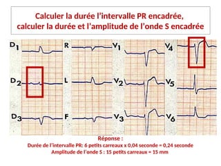 Calculer la durée l’intervalle PR encadrée,
calculer la durée et l’amplitude de l’onde S encadrée
Réponse :
Durée de l’intervalle PR: 6 petits carreaux x 0,04 seconde = 0,24 seconde
Amplitude de l’onde S : 15 petits carreaux = 15 mm
 
