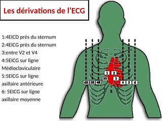 1:4EICD près du sternum
2:4EICG près du sternum
3:entre V2 et V4
4:5EICG sur ligne
Médioclaviculaire
5:5EICG sur ligne
axillaire antérieure
6: 5EICG sur ligne
axillaire moyenne
Les dérivations de l’ECG
 