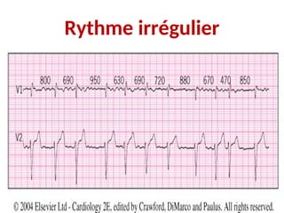 Rythme irrégulier
 