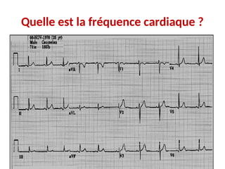 Quelle est la fréquence cardiaque ?
 
