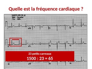 Quelle est la fréquence cardiaque ?
23 petits carreaux
1500 : 23 = 65
 