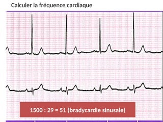 Calculer la fréquence cardiaque
1500 : 29 = 51 (bradycardie sinusale)
 