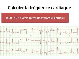 Calculer la fréquence cardiaque
1500 : 10 = 150/minutes (tachycardie sinusale)
 