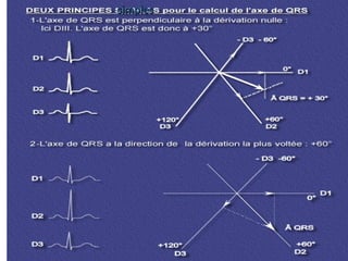 ANALYSE DU COMPLEXE P
QRST
• Calcul de l’axe
simples
simples
 