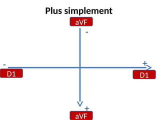 Plus simplement
aVF
aVF
D1 D1
-
- +
+
 