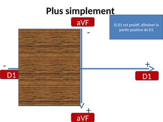 Plus simplement
aVF
aVF
D1 D1
-
- +
+
Si D1 est positif, éliminer la
partie positive de D1
 