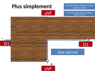 Plus simplement
aVF
aVF
D1 D1
-
- +
+
Si D1 est positif, éliminer la partie
négative de D1
Si aVF est positif, éliminer la partie
négative de aVF
Axe normal
 