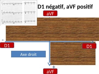 D1 négatif, aVF positif
aVF
aVF
D1 D1
-
- +
+
Axe droit
 