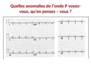 Quelles anomalies de l’onde P voyez-
vous, qu’en pensez – vous ?
 