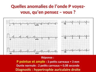 Quelles anomalies de l’onde P voyez-
vous, qu’en pensez – vous ?
Réponse :
P pointue et ample : 3 petits carreaux = 3 mm
Durée normale : 2 petits carreaux = 0,08 seconde
Diagnostic : hypertrophie auriculaire droite
 