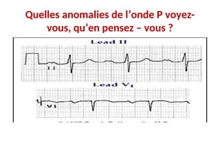 Quelles anomalies de l’onde P voyez-
vous, qu’en pensez – vous ?
 