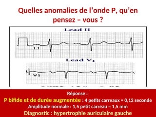 Quelles anomalies de l’onde P, qu’en
pensez – vous ?
Réponse :
P bifide et de durée augmentée : 4 petits carreaux = 0,12 seconde
Amplitude normale : 1,5 petit carreau = 1,5 mm
Diagnostic : hypertrophie auriculaire gauche
 