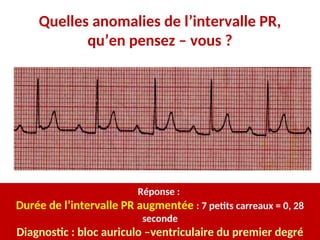 Quelles anomalies de l’intervalle PR,
qu’en pensez – vous ?
Réponse :
Durée de l’intervalle PR augmentée : 7 petits carreaux = 0, 28
seconde
Diagnostic : bloc auriculo –ventriculaire du premier degré
 