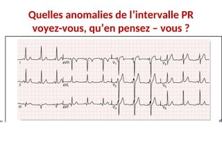 Quelles anomalies de l’intervalle PR
voyez-vous, qu’en pensez – vous ?
 