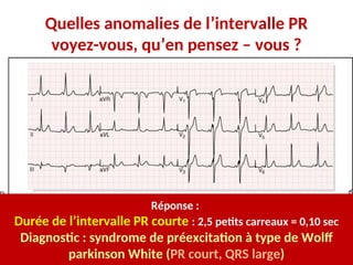 Quelles anomalies de l’intervalle PR
voyez-vous, qu’en pensez – vous ?
Réponse :
Durée de l’intervalle PR courte : 2,5 petits carreaux = 0,10 sec
Diagnostic : syndrome de préexcitation à type de Wolff
parkinson White (PR court, QRS large)
 