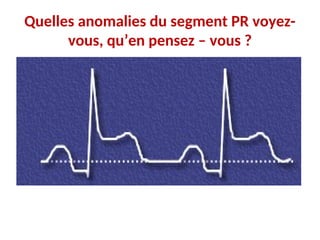 Quelles anomalies du segment PR voyez-
vous, qu’en pensez – vous ?
 