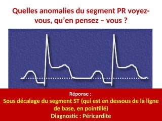 Quelles anomalies du segment PR voyez-
vous, qu’en pensez – vous ?
Réponse :
Sous décalage du segment ST (qui est en dessous de la ligne
de base, en pointillé)
Diagnostic : Péricardite
 