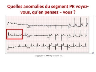 Quelles anomalies du segment PR voyez-
vous, qu’en pensez – vous ?
 