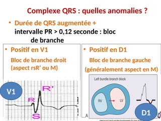 Complexe QRS : quelles anomalies ?
• Durée de QRS augmentée +
intervalle PR > 0,12 seconde : bloc
de branche
• Positif en V1
Bloc de branche droit
(aspect rsR’ ou M)
• Positif en D1
Bloc de branche gauche
(généralement aspect en M)
V1
D1
 