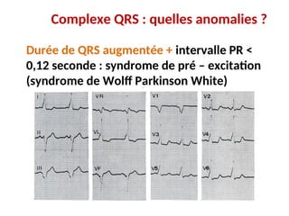 Complexe QRS : quelles anomalies ?
Durée de QRS augmentée + intervalle PR <
0,12 seconde : syndrome de pré – excitation
(syndrome de Wolff Parkinson White)
 