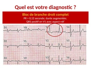 Quel est votre diagnostic ?
Bloc de branche droit complet
PR > 0,12 seconde; durée augmentée;
QRS positif en V1 avec aspect rsR’
 