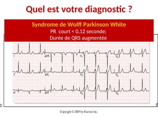Quel est votre diagnostic ?
Syndrome de Wolff Parkinson White
PR court < 0,12 seconde;
Durée de QRS augmentée
 