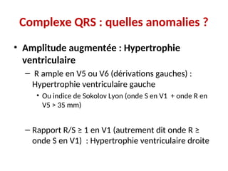 Complexe QRS : quelles anomalies ?
• Amplitude augmentée : Hypertrophie
ventriculaire
– R ample en V5 ou V6 (dérivations gauches) :
Hypertrophie ventriculaire gauche
• Ou indice de Sokolov Lyon (onde S en V1 + onde R en
V5 > 35 mm)
– Rapport R/S ≥ 1 en V1 (autrement dit onde R ≥
onde S en V1) : Hypertrophie ventriculaire droite
 