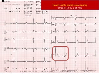 Complexe QRS : quelles anomalies ?
• Amplitude augmentée : Hypertrophie
ventriculaire
– R ample en V5 ou V6 (dérivations gauches) :
Hypertrophie ventriculaire gauche
• Ou indice de Sokolov Lyon (onde S en V1 + onde R en
V5 > 35 mm)
– Rapport R/S ≥ 1 en V1 (autrement dit onde R ≥
onde S en V1) : Hypertrophie ventriculaire droite
Hypertrophie ventriculaire gauche
Onde R en V5 à 26 mm
 