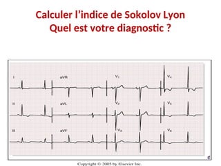 Calculer l’indice de Sokolov Lyon
Quel est votre diagnostic ?
 
