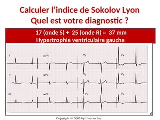 Calculer l’indice de Sokolov Lyon
Quel est votre diagnostic ?
17 (onde S) + 25 (onde R) = 37 mm
Hypertrophie ventriculaire gauche
 