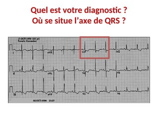 Quel est votre diagnostic ?
Où se situe l’axe de QRS ?
 