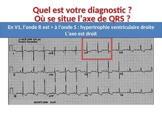 En V1, l’onde R est > à l’onde S : hypertrophie ventriculaire droite
L’axe est droit
Quel est votre diagnostic ?
Où se situe l’axe de QRS ?
 