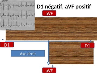 D1 négatif, aVF positif
aVF
aVF
D1 D1
-
- +
+
Axe droit
 