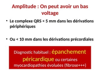 Amplitude : On peut avoir un bas
voltage
• Le complexe QRS < 5 mm dans les dérivations
périphériques
• Ou < 10 mm dans les dérivations précordiales
Diagnostic habituel : épanchement
péricardique ou certaines
myocardiopathies évoluées (fibrose+++)
 