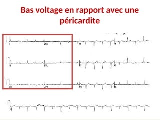Bas voltage en rapport avec une
péricardite
 