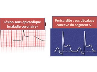 6ème heure
6ème heure
Lésion sous épicardique
(maladie coronaire)
Péricardite : sus décalage
concave du segment ST
 