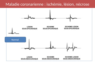 Normal
Maladie coronarienne : ischémie, lésion, nécrose
 