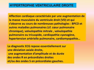 HYPERTROPHIE VENTRICULAIRE DROITE
Affection cardiaque caractérisée par une augmentation de
la masse musculaire du ventricule droit (VD) et qui
s’observe au cours de nombreuses pathologies : BPCO et
autres maladies pulmonaires (cf. cœur pulmonaire
chronique), valvulopathie mitrale , valvulopathie
pulmonaire ou tricuspide, cardiopathie cyanogène,
hypertension artérielle pulmonaire, cardiomyopathie…

Le diagnostic ECG repose essentiellement sur
une déviation axiale droite,
une augmentation d’amplitude et de durée
des ondes R en précordiales droites
et/ou des ondes S en précordiales gauches.

 