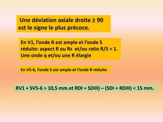 Une déviation axiale droite ≥ 90
est le signe le plus précoce.
En V1, l’onde R est ample et l’onde S
réduite: aspect R ou Rs et/ou ratio R/S > 1.
Une onde q et/ou une R élargie
En V5-6, l’onde S est ample et l’onde R réduite

RV1 + SV5-6 > 10,5 mm.et RDI + SDIII) – (SDI + RDIII) < 15 mm.

 