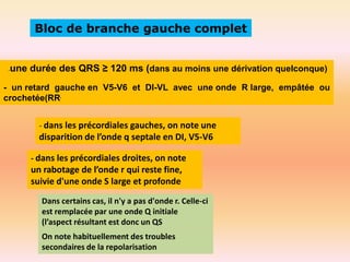 Bloc de branche gauche complet

-

une durée des QRS ≥ 120 ms (dans au moins une dérivation quelconque)

- un retard gauche en V5-V6 et DI-VL avec une onde R large, empâtée ou
crochetée(RR'
- dans les précordiales gauches, on note une

disparition de l’onde q septale en DI, V5-V6
- dans les précordiales droites, on note

un rabotage de l’onde r qui reste fine,
suivie d'une onde S large et profonde
Dans certains cas, il n'y a pas d'onde r. Celle-ci
est remplacée par une onde Q initiale
(l’aspect résultant est donc un QS

On note habituellement des troubles
secondaires de la repolarisation

 