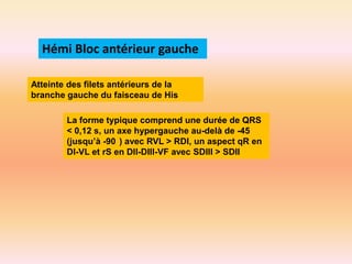 Hémi Bloc antérieur gauche
Atteinte des filets antérieurs de la
branche gauche du faisceau de His
La forme typique comprend une durée de QRS
< 0,12 s, un axe hypergauche au-delà de -45
(jusqu’à -90 ) avec RVL > RDI, un aspect qR en
DI-VL et rS en DII-DIII-VF avec SDIII > SDII

 