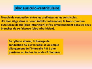 Bloc auriculo-ventriculaire
Trouble de conduction entre les oreillettes et les ventricules.
•Ce bloc siège dans le nœud AV(bloc intranodal), le tronc commun
dufaisceau de His (bloc intrahisien) et/ou simultanément dans les deux
branches de ce faisceau (bloc infra-hisien).

En rythme sinusal, le blocage de
conduction AV est variable, d’un simple
allongement de l’intervalle P-R à une,
plusieurs ou toutes les ondes P bloquées.

 
