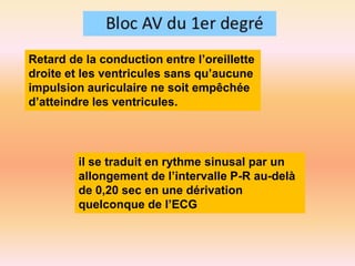 Retard de la conduction entre l’oreillette
droite et les ventricules sans qu’aucune
impulsion auriculaire ne soit empêchée
d’atteindre les ventricules.

il se traduit en rythme sinusal par un
allongement de l’intervalle P-R au-delà
de 0,20 sec en une dérivation
quelconque de l’ECG

 