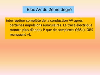 interruption complète de la conduction AV après
certaines impulsions auriculaires. Le tracé électrique
montre plus d’ondes P que de complexes QRS (« QRS
manquant »).

 