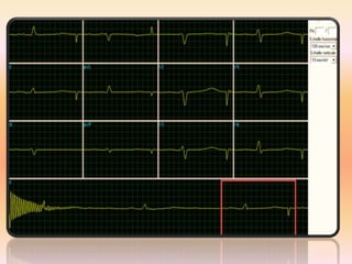 ECG formation accélérée