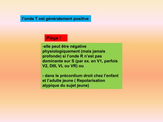 l’onde T est généralement positive

Piège !
-elle peut être négative
physiologiquement (mais jamais
profonde) si l’onde R n’est pas
dominante sur S (par ex. en V1, parfois
V2, DIII, VL ou VR) ou
- dans le précordium droit chez l’enfant
et l’adulte jeune ( Repolarisation
atypique du sujet jeune)

 