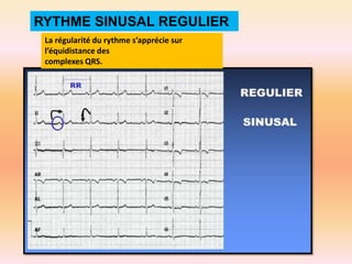 RYTHME SINUSAL REGULIER
La régularité du rythme s’apprécie sur
l’équidistance des
complexes QRS.

 