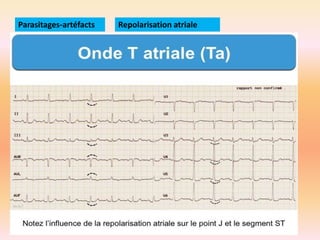 Parasitages-artéfacts

Repolarisation atriale

Restauration de la polarisation membranaire
des oreillettes après leurs dépolarisations.
L’onde Ta est légèrement concave avec une
polarité inversée à l’onde P

PIEGES
En cas de péricardite aiguë, l’onde Ta prend
l’aspect d’un sous-décalage du PQ, franc,
concave vers le haut.

 