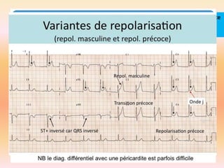 Parasitages-artéfacts

PIEGES

Repolarisation atriale

Repolarisation précoce
et repolarisation
masculine

 